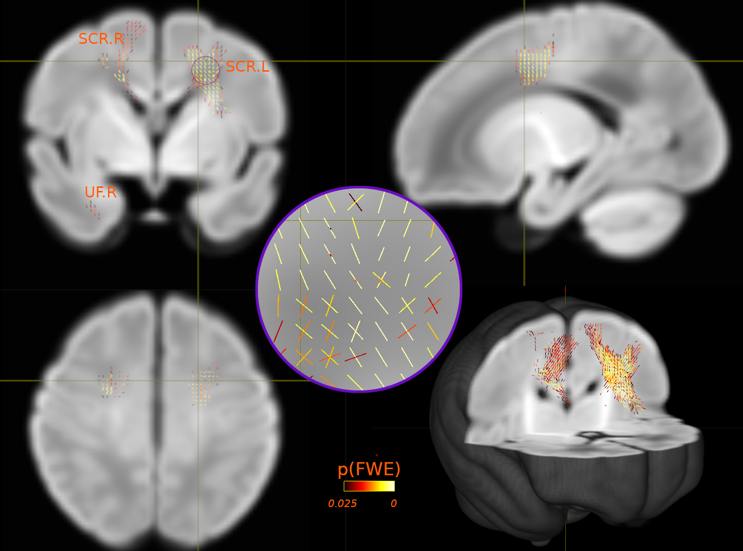 Exploring Genetic Links: Neuroimaging Insights into Autism and Schizophrenia