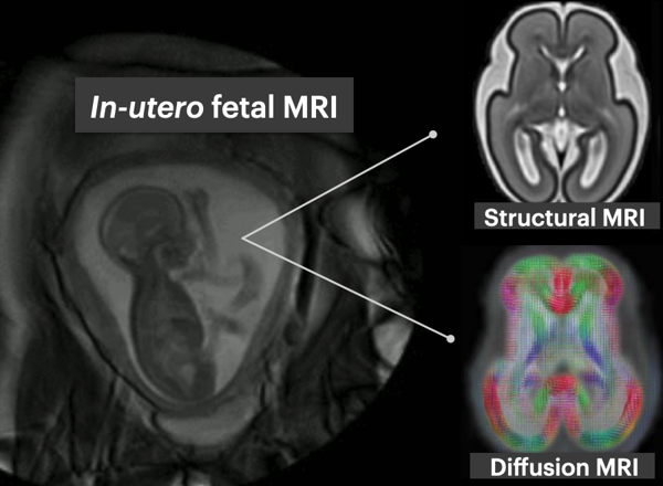 Exploring early fetal brain development: a deep learning approach