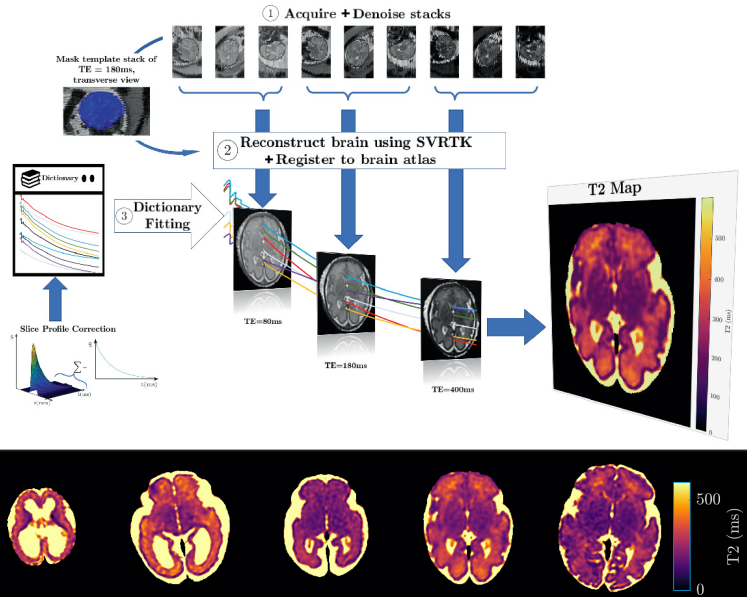 Quantitative Fetal measurements in MRI