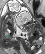 Deformable Slice-to-Volume Registration for Motion Correction of Fetal Body and Placenta MRI