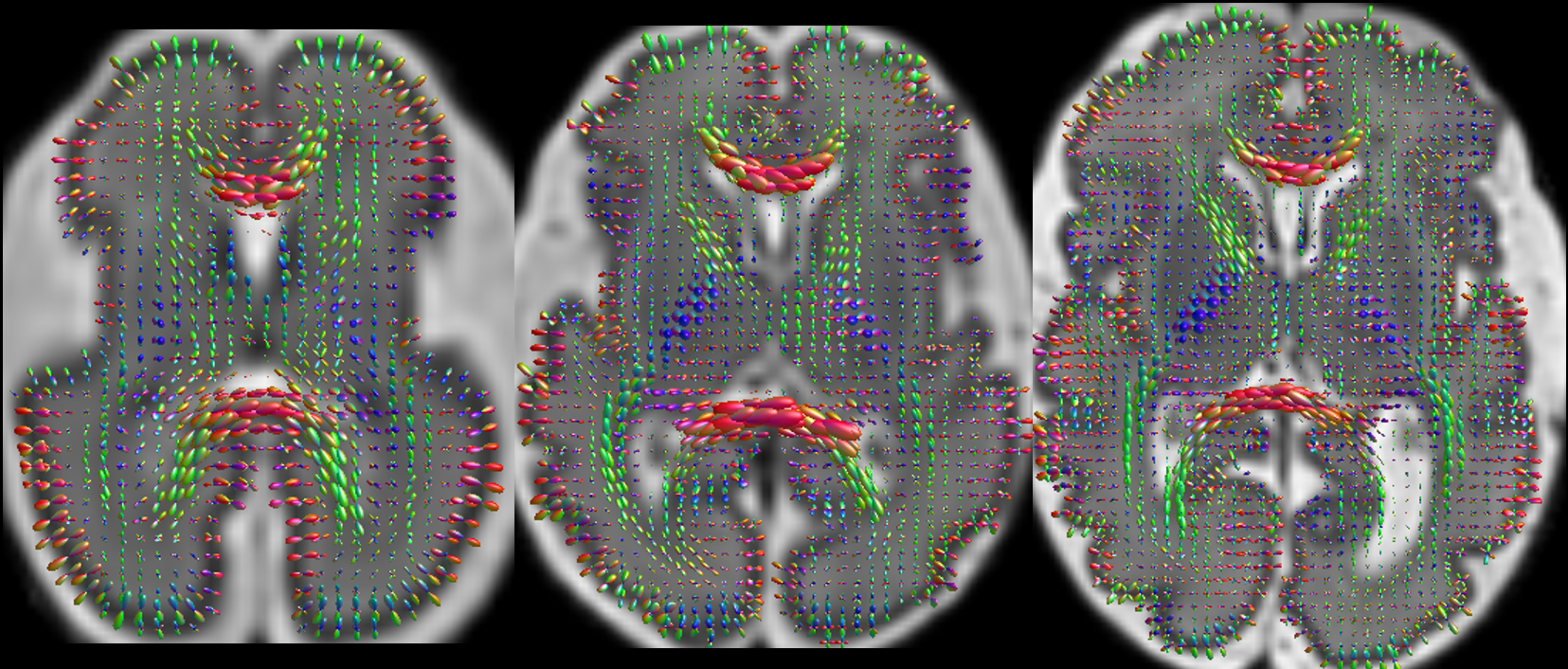 Higher Order Spherical Harmonics Reconstruction of Fetal Diffusion MRI With Intensity Correction