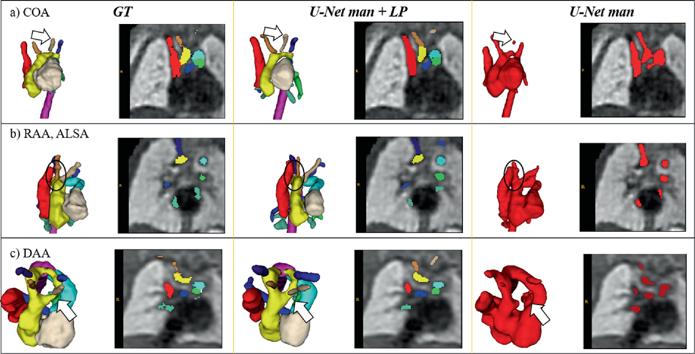 Automated Multi-class Fetal Cardiac Vessel Segmentation