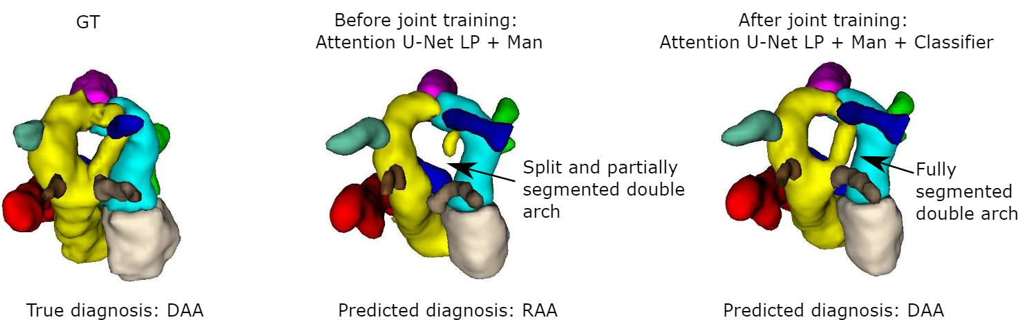 Multi-task learning for joint weakly-supervised segmentation and aortic arch anomaly classification in fetal cardiac MRI