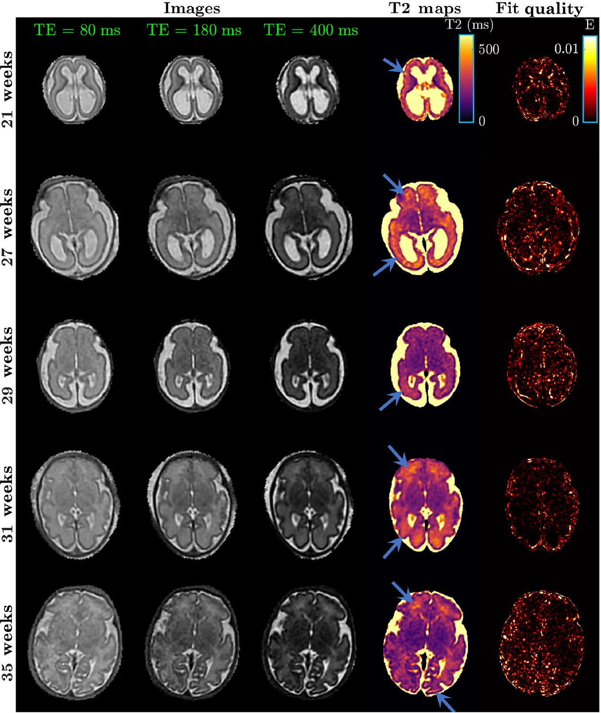 In vivo T2 measurements of the fetal brain using single-shot fast spin echo sequences