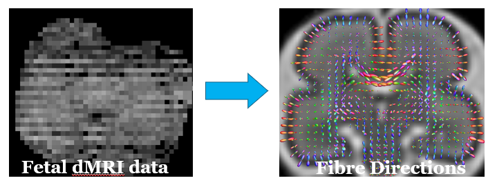 Motion correction of fetal brain MRI