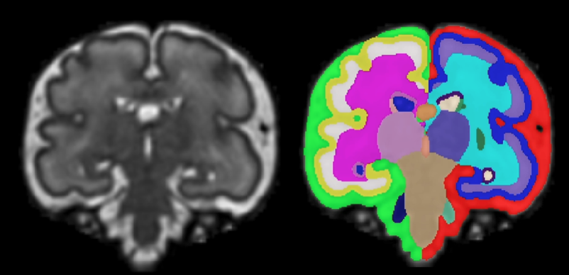 Fetal brain transient segmentation