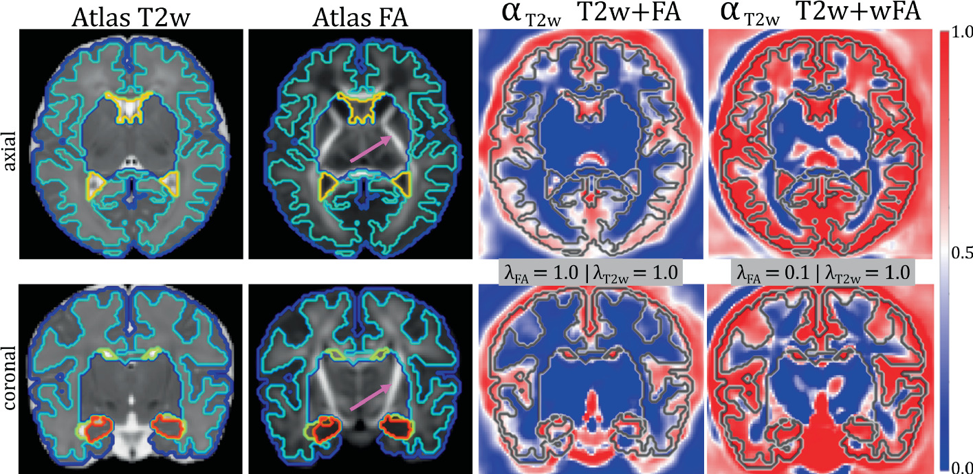 Attention-driven multi-channel deformable registration of structural and microstructural neonatal data