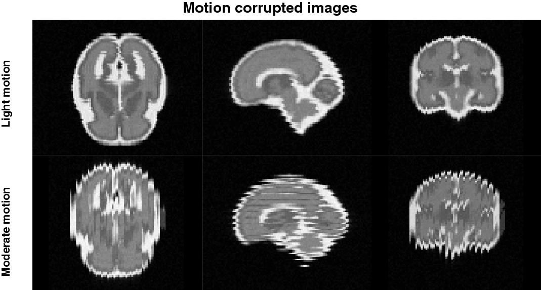 Fetal SS FSE Simulation - A modified FaBiAN phantom